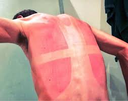 Weil die sonne unsere haut, unsere zellen und letztlich die erbinformationen schädigen kann. Sonnenbrand Unter Dem Radtrikot Richtig Vorbeugen Querbeet Https Ilovecycling De