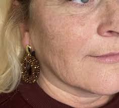 Cheekbone fillers from £155