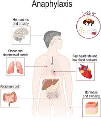 Image result for Exercise-Induced Anaphylaxis