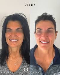 Exciting Announcement! 🌟 Please join us in giving a warm welcome to Stephanie  Sears, Medical Esthetician, to the VITRA Aesthetics Clinic team! 🎉⁠ ⁠ With  20 years of expertise in advanced aesthetics,