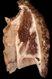 Mesothelioma, also known as malignant mesothelioma . Malignant Pleural Mesothelioma Lung Preparation Doccheck