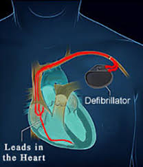 More advanced devices (icd, implantable cardioverter defibrillator; Phoenix Defibrillator Placement Phoenix Cath Lab