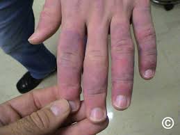 Image result for Chilblains