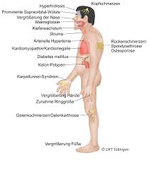 Tumoren Der Hypophyse Uniklinik Tubingen Neurochirurgie
