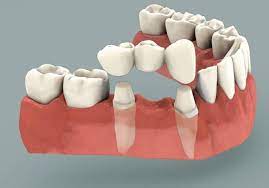 Reasons That Make Dental Implants The Best Treatment For Missing Natural Teeth Dental Bridge Dental Implants Dental Crowns