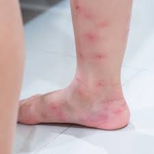 Image result for ant bite