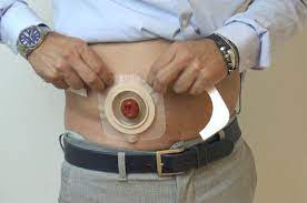 A stoma is an opening on the surface of the abdomen which has been surgically created to . Stomie Come Scegliere Il Dispositivo Giusto