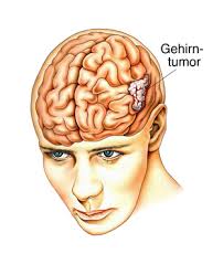 Gehirntumor Ursachen Beschwerden Therapie Gesundpedia De