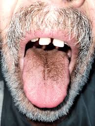 Image result for black hairy tongue symptoms