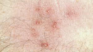 Image result for mite bites on humans