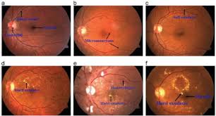 You should plan to make regular eye doctor visits when you have diabetes.high blood sugar can lead to problems like blurry vision, cataracts, glaucoma, and retinopathy.in fact, diabetes is. Diabetic Retinopathy Detection Through Deep Learning Techniques A Review Sciencedirect