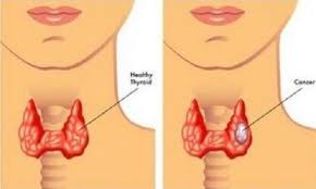 What throat cancer look like. Throat Cancer Types Facts Symptoms Signs Of Throat Cancer Sandybook