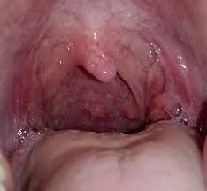 I Have Strange Bumps On The Back Of My Throat Sore Throat From 2 Months And No Coughing Sore Throat Forums Patient