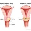 Abdominal or pelvic pain or tenderness blood in the urine 1