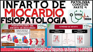 El infarto agudo al miocardio ocurre como consecuencia. Infarto Agudo Al Miocardio Fisiopatologia Guiamed Youtube