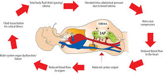 Cardiovascular effects of intra-abdominal hypertension: current perspectives