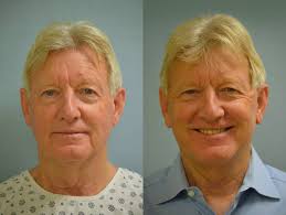 Facelift surgery can help smooth wrinkles and tighten loose skin. Mini Facelift San Diego Ca Esthetica Center For Cosmetic Surgery