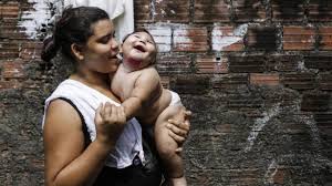 Die stark vermutete verbindung zwischen dem virus und der mikrozephalie hat die weltgesundheitsorganisation dazu veranlasst, zu erklären, dass der ausbruch ein public health notfall von international concern ist. Zika Infektionen In Brasilien Wie Geht Es Den Betroffenen Kindern Heute Archiv