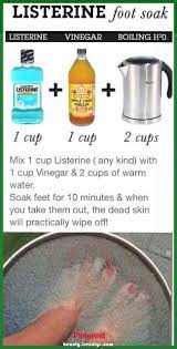Listerine Foot Soak Footsoakfordryfeet Footsoakfordryfeet Listerine Pretty Listerine Foot Soak Footsoakfo I Foot Remedies Listerine Foot Soak Feet Care