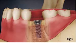 Toothpaste that gives you a healthy smile, with specialized solutions tailored to you. How Much Is The Cost Of A Tooth Implant In The Philippines