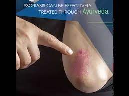 الصدفية علاج الصدفية مرض الصدفية الصدفيه الصدفية وعلاجها علاج الصدفية بالاعشاب صدفية الجلد علاج الصدفية بالعسل صدفية ال psoriasis ayurveda ayurvedic