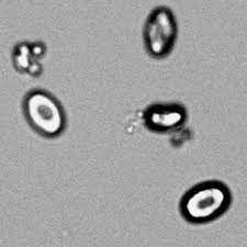 La présence de cristaux d'oxalate de calcium élevant énormément ordinaire ensuite a habituellement vaguement de signification clinique. Hyperoxalurie Primitive Sciencedirect