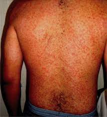 Epidemic typhus has similar but more severe symptoms. Endemic Typhus Archives The Western Journal Of Emergency Medicine