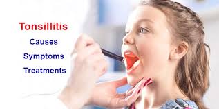 The most common places in the oropharynx for cancer to develop are on the tonsils and the base of the tongue. Tonsillitis Tonsil Stones And Cancer Causes Symptoms And Treatments