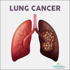 Check spelling or type a new query. Lung Cancer Causes Symptoms And Treatment Netmeds