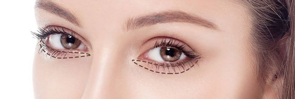 Blepharoplasty in Paris | Eyelid Surgery | Avenue Foch