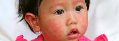Image result for red rash face
