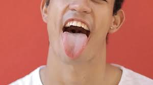 Image result for Fissured tongue