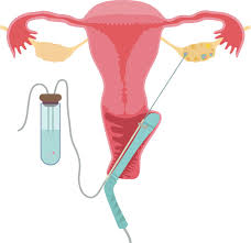 Vuk jovanovic on february 01, 2016 in the initial days of in vitro fertilization (ivf) technology was not advanced enough to support transvaginal egg retrieval using an ultrasound. Egg Collection During Ivf What Is The Ideal Amount Ivf Specialist Perth