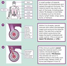 Image result for Extrapulmonary Tuberculosis