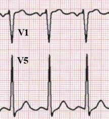 1 lvh criteria sokolow + lyon s v1+ r v5 or v6 > 35 mm cornell criteria (circulation, 1987;3: Left Ventricular Hypertrophy Wikem