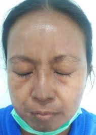 Sindrom Hipersensitivitas Dapson pada Pasien Morbus Hansen Multi- Basiler:  Laporan Kasus