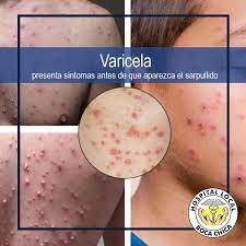 Hospital Local Boca Chica On Twitter La Mayoria De Los Ninos Con Varicela Presentan Los Siguientes Sintomas Antes De Que Aparezca El Sarpullido Fiebre Dolor De Cabeza Dolor De