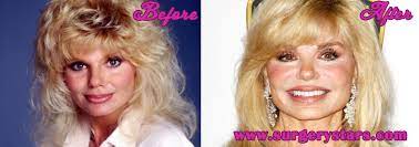 Everything you need to know about loni anderson plastic surgeries, botox, breast implants etc. Loni Anderson Plastic Surgery Before After Pic