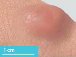 Image result for Nodule