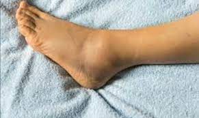 Baru2 ni aku ada borak ngan sorg kawan kat opis. Tanda Sakit Buah Pinggang Yang Perlu Anda Ketahui