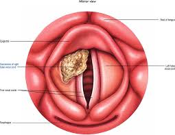 Excerpt from what you need to know about cancer of the. What Are The Signs Of Laryngeal Cancer