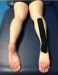 Image result for Taping for Soleus and Achilles