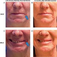 Chi-square test showing the association between Bell's palsy affected...