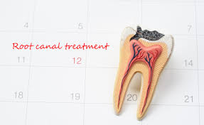 Inflamed tissue around the gums Root Canal Procedure Who Performs It And What Does It Cost