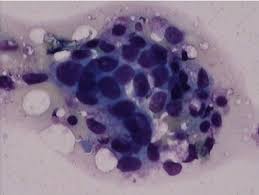 At the ohsu knight cancer institute, we consider every person with blood cancer for a stem cell transplant. Histopathology Of Bone Marrow Adenoid Cancer Cells Were Seen In The Download Scientific Diagram