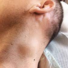 Lipom Liposarkom Ursache Symptome Diagnose Entfernung