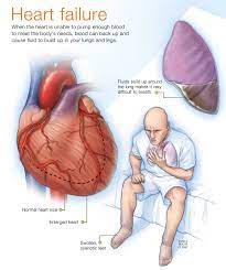 Heart Failure Heart Failure Heart Failure Treatment Heart Failure Heart Attack Treatment