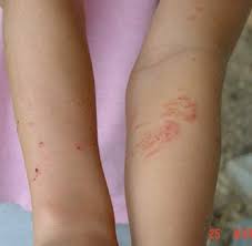 I planted these bushes at my rural. Rash Pictures Most From Contact With Poison Ivy Poison Oak Or Poison Sumac Urushiol Oil Www Poisonivy Us