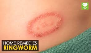 Population at any given time. Ringworm Home Remedies Health Tone Tips Video Dailymotion