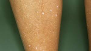 Hypomelanosis Guttata Altmeyers Enzyklopadie Fachbereich Dermatologie